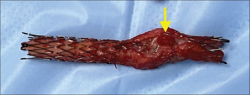 vsijournalijves's tweet photo. "Thrombosed Subclavian stent in aTOS explanted by @pcvasc and team—proof that knowing how isn’t enough. When to stent makes all the difference. #VascularSurgery #inthebucket
@farkomd @Kuldeep1926 @RMotaganahalli https://t.co/gGqA0cP4tU https://t.co/fCXvDPfA9O