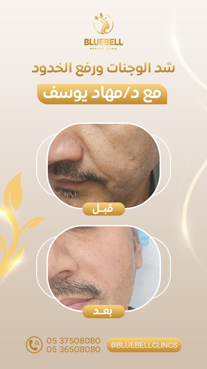 BluebellClinics's tweet photo. ✨ بلمسات بسيطة فرق كبير
نتائج 1 مل شد الوجنات ورفع الخدود بملامح مشدودة وجمال طبيعي.
📍 عيادات بلو بيل – لأنك تستحقين الأفضل.
📞 للحجز والاستفسار:
📞 0536508080
📞 0537508080
#بلو_بيل #فيلر_شفايف #شد_الخدود #عناية_بجمالك

📷aligoldenali85💪 https://t.co/1R5Ha3REVM