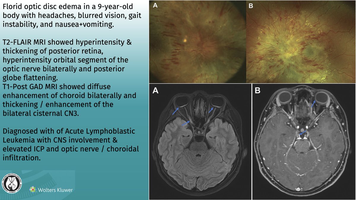 Leukemic Optic Neuropathy: Journal of Neuro-Ophthalmology
Article: bit.ly/JNO_Leukemic_o…
 #brain #eye #vision #research #Neurology #NeuroOphth #Ophthalmology #Medicine #Cancer #Leukemia