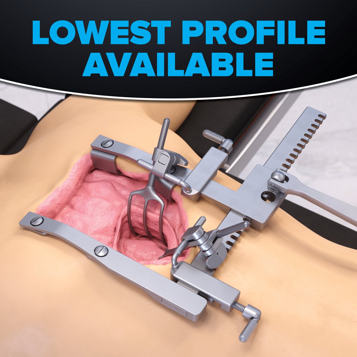 ThompsonRetract's tweet image. The Bolling Retractor System accomplishes a low-profile set up by combining short handles and a frame that sits just above the spreader. #ThompsonRetractor #BollingSystem