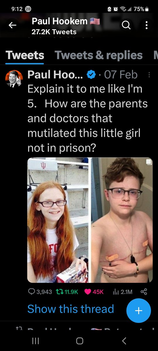 DClinite's tweet image. Look at the difference. Before she's butchered and being groomed with love and attention. After, once the permanent reality is so obvious her young mind gets what they did to her.  So Sad! So EVIL!