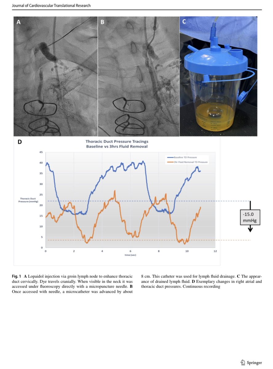 Jeffrey F. B. Chick, MD, MPH (@chickvir) on Twitter photo Lymphatic dysfunction contributes to congestion and end-organ damage in heart failure. Thoracic duct drainage may provide a novel treatment option.
link-springer-com.libproxy1.usc.edu/content/pdf/10โฆ
<a href="/CVIR_Journal/">CVIR Journal</a> <a href="/cvirendo/">CVIR Endovascular (Jim Reekers, Editor-in-Chief)</a> <a href="/JVIRmedia/">JVIR</a> <a href="/SIRspecialists/">Society of Interventional Radiology</a> <a href="/USC/">USC</a> <a href="/EVToday/">Endovascular Today</a> <a href="/UWRadiology/">UW Radiology</a> <a href="/VenousNews/">Venous News</a> Lymphatic dysfunction contributes to congestion and end-organ damage in heart failure. Thoracic duct drainage may provide a novel treatment option.
link-springer-com.libproxy1.usc.edu/content/pdf/10โฆ
<a href="/CVIR_Journal/">CVIR Journal</a> <a href="/cvirendo/">CVIR Endovascular (Jim Reekers, Editor-in-Chief)</a> <a href="/JVIRmedia/">JVIR</a> <a href="/SIRspecialists/">Society of Interventional Radiology</a> <a href="/USC/">USC</a> <a href="/EVToday/">Endovascular Today</a> <a href="/UWRadiology/">UW Radiology</a> <a href="/VenousNews/">Venous News</a>