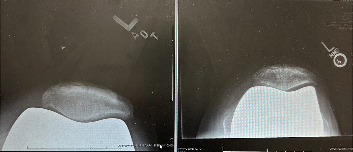17 years without a patellar button. Asymptomatic.