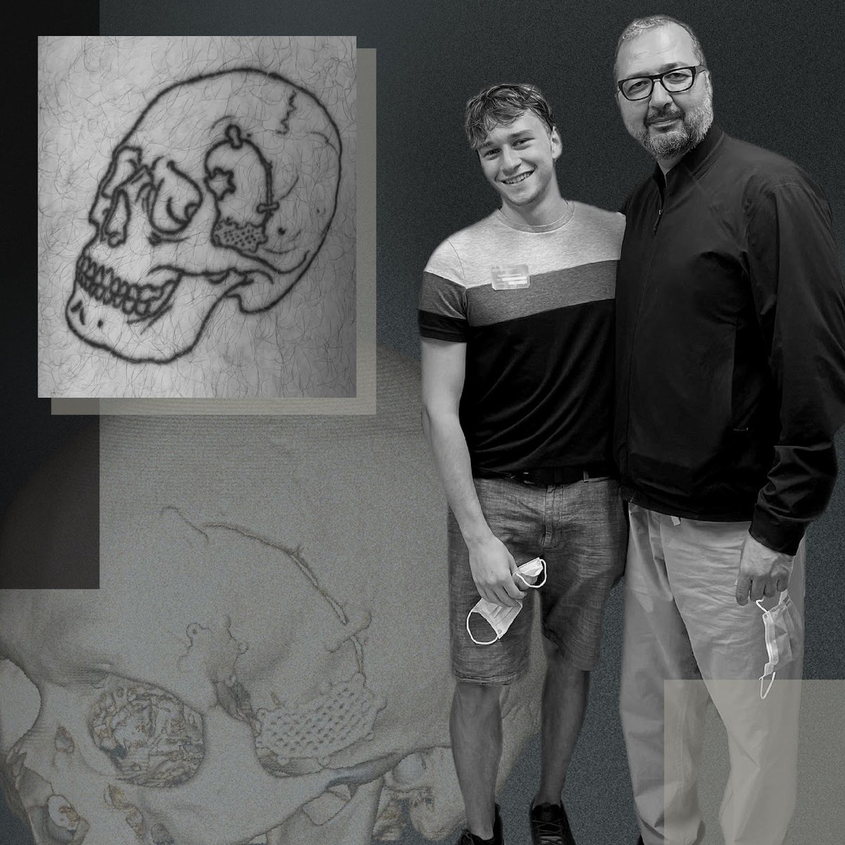Our client, <a href="/draliazizsultan/">Ali Sultan</a>, is a world-class neurosurgeon who truly cares! 🧠💪 His patient, Dylan, survived a ruptured aneurysm &amp; he turned his recovery into art with a tattoo of his craniotomy. 🎨✨ Inspired by both, we created a graphic to celebrate their powerful journey!
