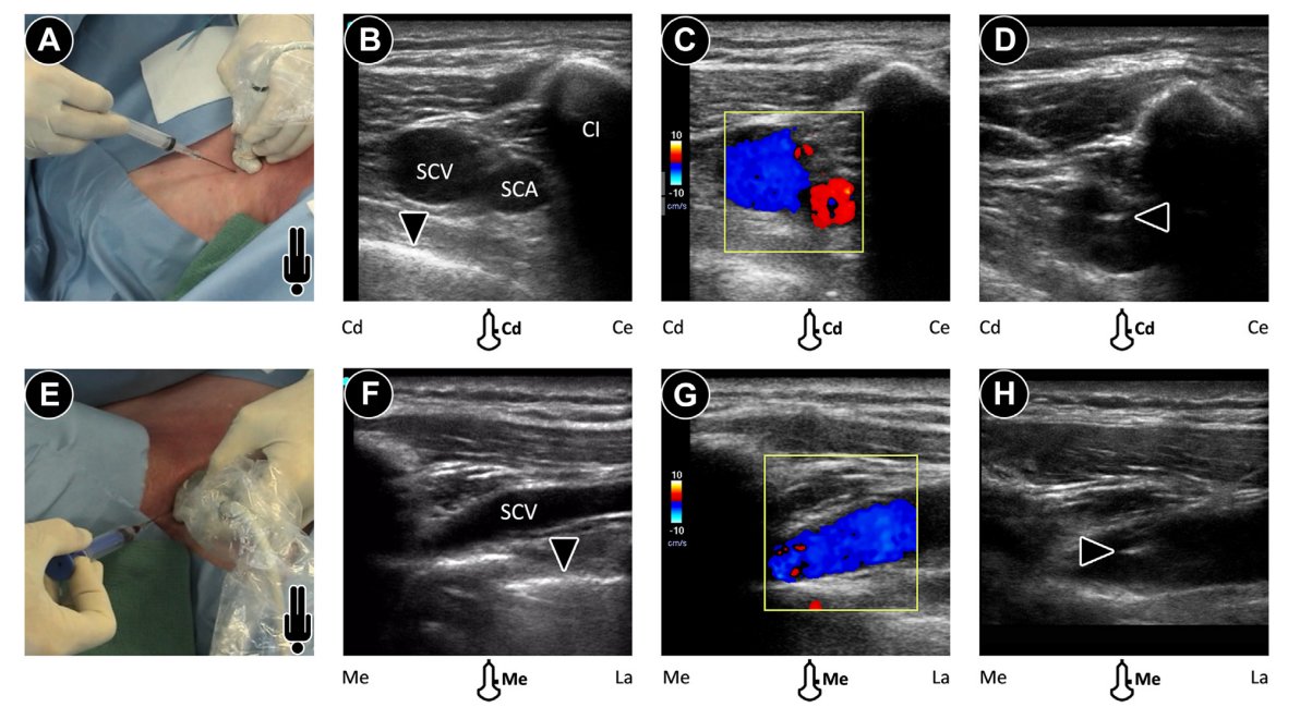 🫀NEW GUIDELINE🫀 bit.ly/413fdGt
Read our newest #ASEGuideline, "Guidelines for Performing Ultrasound-Guided Vascular Cannulation: Recommendations of the American Society of Echocardiography!"