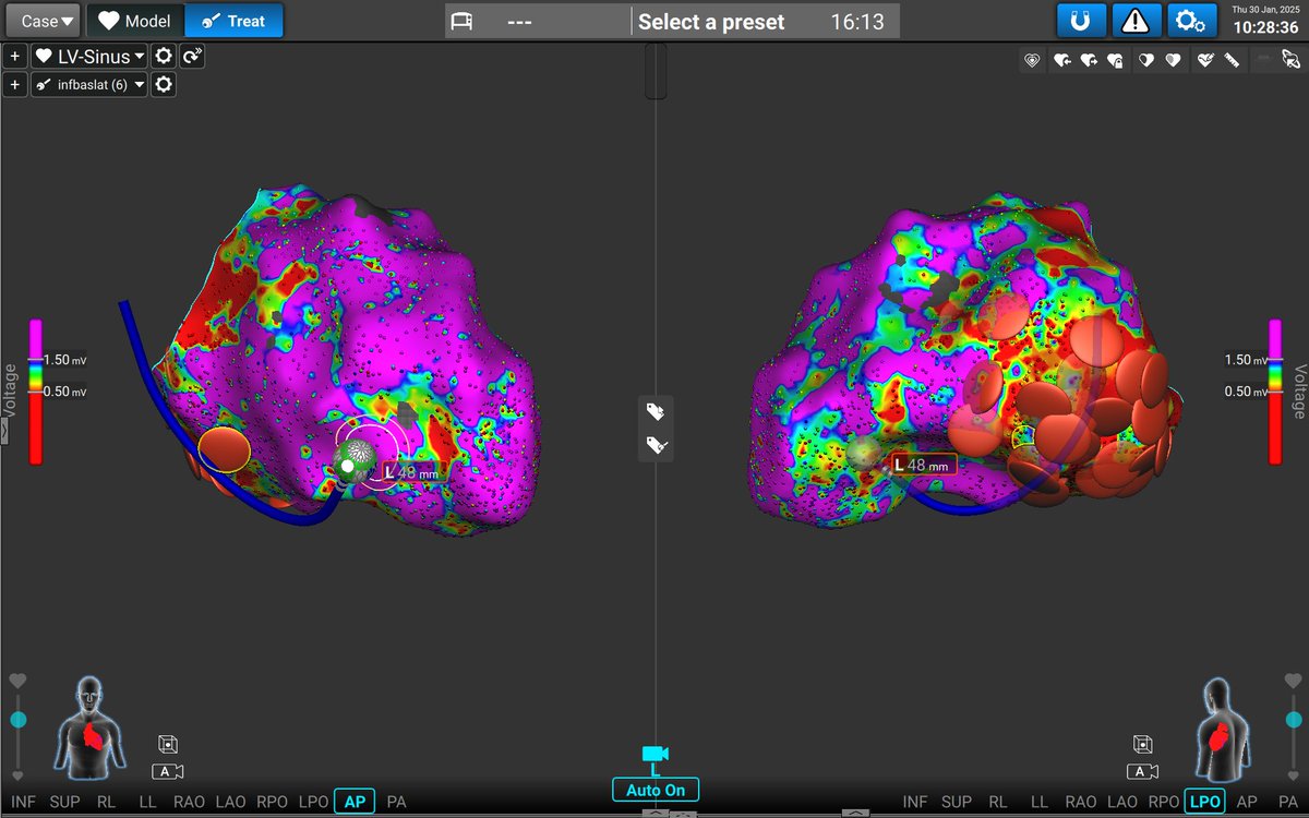 Andreas Metzner (@andreasmetzner7) on Twitter photo 🤜#Affera @UKE Hamburg: Ischemic VT - big and effective ablation lesions at an infero-basal substrate using the #SPHERE9 catheter. An effective option for extensive substrates. There is a lot more to learn.🫀🙏
<a href="/AndreasRillig/">Andreas Rillig</a> <a href="/laura_rottner/">Laura Rottner</a> <a href="/chris_sohns/">Christian Sohns</a> <a href="/jongichun/">Julian Chun</a> 🤜#Affera @UKE Hamburg: Ischemic VT - big and effective ablation lesions at an infero-basal substrate using the #SPHERE9 catheter. An effective option for extensive substrates. There is a lot more to learn.🫀🙏
<a href="/AndreasRillig/">Andreas Rillig</a> <a href="/laura_rottner/">Laura Rottner</a> <a href="/chris_sohns/">Christian Sohns</a> <a href="/jongichun/">Julian Chun</a>