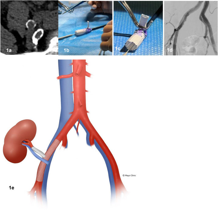 Shennen Mao, MD (@shennenmao) on Twitter photo Excited to offer kidney transplant to individuals with significant atherosclerosis utilizing a novel physician-modified stent graft.
nam12.safelinks.protection.outlook.com/?url=https%3A%…<a href="/MayoTransplant/">Mayo Clinic Transplant</a> <a href="/MCTransplntSurg/">Mayo Clinic Transplantation Surgery</a> Excited to offer kidney transplant to individuals with significant atherosclerosis utilizing a novel physician-modified stent graft.
nam12.safelinks.protection.outlook.com/?url=https%3A%…<a href="/MayoTransplant/">Mayo Clinic Transplant</a> <a href="/MCTransplntSurg/">Mayo Clinic Transplantation Surgery</a>