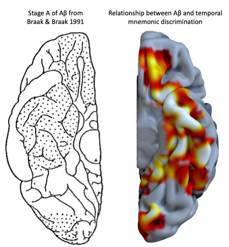 Casey Vanderlip (@caseyvanderlip) on Twitter photo <a href="/mike_yassa/">Mike Yassa</a> <a href="/jennanadams/">Jenna Adams</a> <a href="/SfNJournals/">SfN Journals</a> 7/ To confirm, a voxel-wise analysis revealed that basal frontotemporal Aβ strongly related to temporal mnemonic discrimination deficits, reinforcing our hypothesis and these areas largely mirror the first areas the develop Aβ deposition, as described by Braak & Braak. <a href="/mike_yassa/">Mike Yassa</a> <a href="/jennanadams/">Jenna Adams</a> <a href="/SfNJournals/">SfN Journals</a> 7/ To confirm, a voxel-wise analysis revealed that basal frontotemporal Aβ strongly related to temporal mnemonic discrimination deficits, reinforcing our hypothesis and these areas largely mirror the first areas the develop Aβ deposition, as described by Braak & Braak.