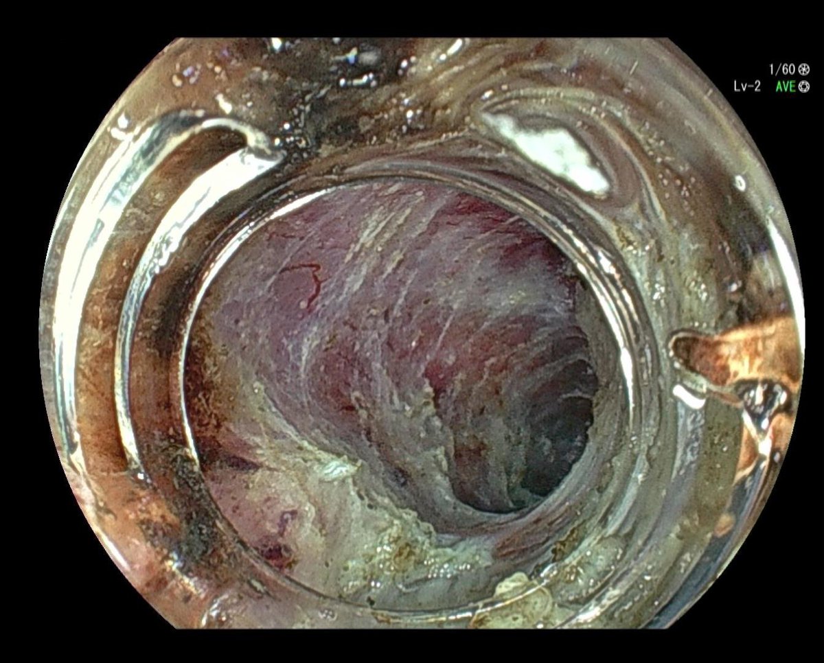 YeseongDavid's tweet photo. Esophageal POEM with new thin gastroscope. 7.9mm tube diameter with 3.2mm instrument channel! https://t.co/f9IemdBrwS