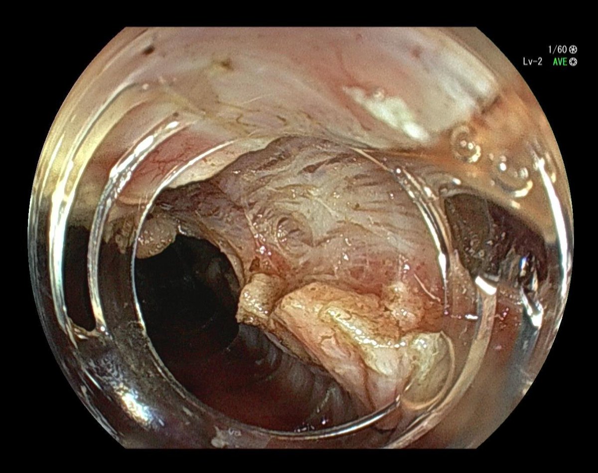 YeseongDavid's tweet photo. Esophageal POEM with new thin gastroscope. 7.9mm tube diameter with 3.2mm instrument channel! https://t.co/f9IemdBrwS