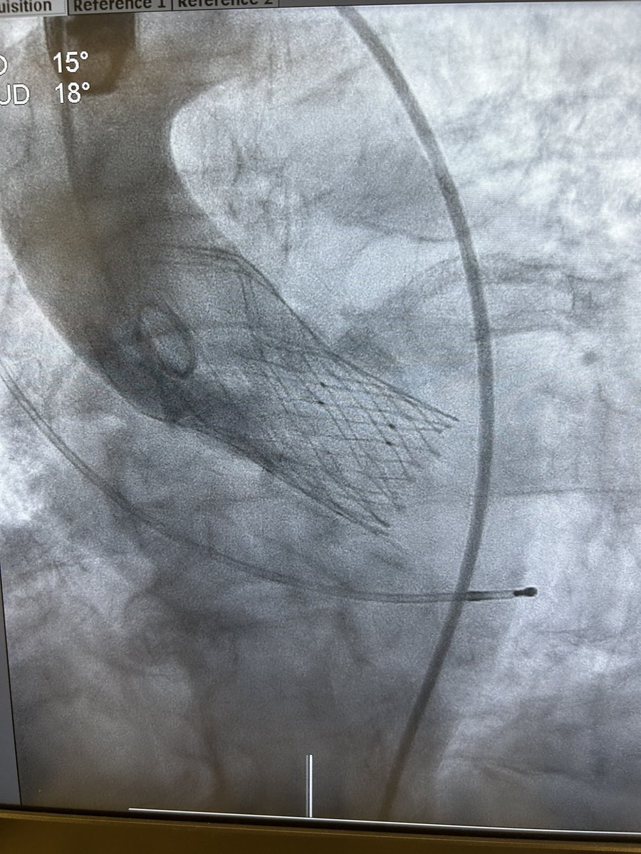 IberiaSmt's tweet photo. Primeros casos de TAVI #Hydra en las Islas Canarias. Enhorabuena @pemarlor08 por su excelente liderazgo pionero en innovación y a todo el equipo de Hemodinámica del Hospital Dr. Negrin por su perfecto soporte. Excelente resultado con mínimos gradientes y ausencia de PVL. Gracias al magnífico apoyo de nuestro Proctor @icruzgonzalez para asegurar un resultado óptimo. 

@shci_sec @SMTStents @damasovha 

#Hydra #TAVI