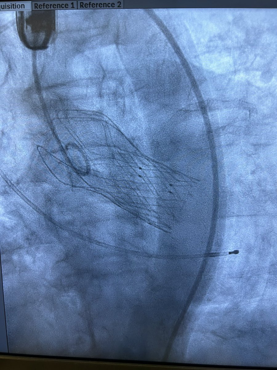 IberiaSmt's tweet photo. Primeros casos de TAVI #Hydra en las Islas Canarias. Enhorabuena @pemarlor08 por su excelente liderazgo pionero en innovación y a todo el equipo de Hemodinámica del Hospital Dr. Negrin por su perfecto soporte. Excelente resultado con mínimos gradientes y ausencia de PVL. Gracias al magnífico apoyo de nuestro Proctor @icruzgonzalez para asegurar un resultado óptimo. 

@shci_sec @SMTStents @damasovha 

#Hydra #TAVI