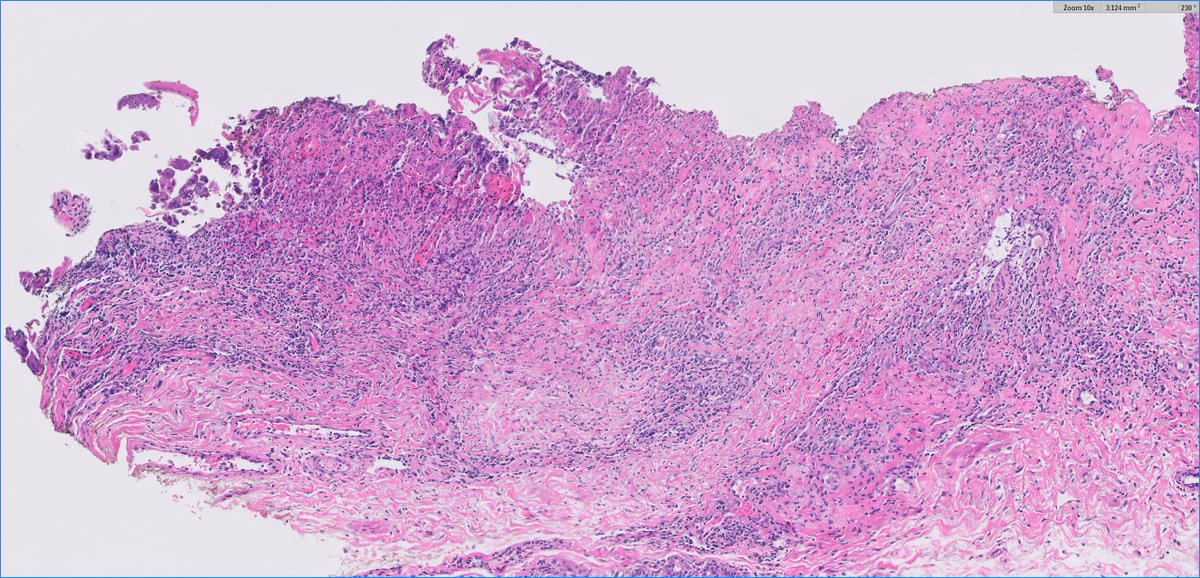 slusagar's tweet image. #GUpath external re-review🔬of penile lesion in a patient with a h/o penile cancer at this site (s/p partial resection a year back)

recurrent cancer?  dysplasia? negative for malignancy?

#pathresidents:  what say you?🤔