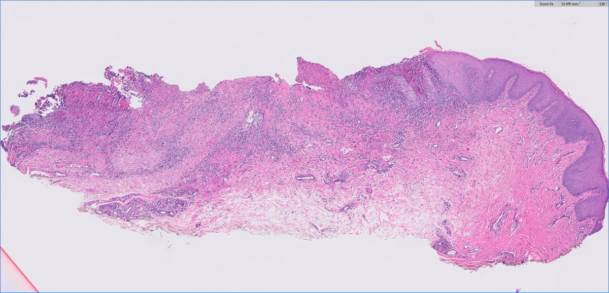 slusagar's tweet image. #GUpath external re-review🔬of penile lesion in a patient with a h/o penile cancer at this site (s/p partial resection a year back)

recurrent cancer?  dysplasia? negative for malignancy?

#pathresidents:  what say you?🤔