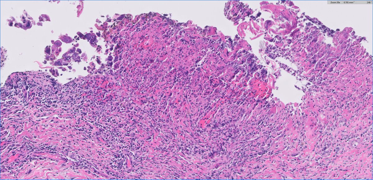 slusagar's tweet image. #GUpath external re-review🔬of penile lesion in a patient with a h/o penile cancer at this site (s/p partial resection a year back)

recurrent cancer?  dysplasia? negative for malignancy?

#pathresidents:  what say you?🤔