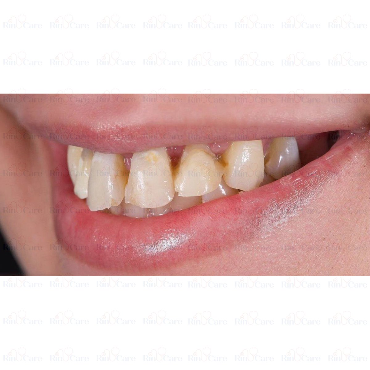 rinucare's tweet photo. #HollywoodSmile #PerfectSmile #CosmeticDentistry #SmileMakeover #SmileGoals #TeethTransformation #BrightSmile #WhiterTeeth #SmileDesign #SmileJourney #HollywoodSmileTurkey #TurkeyDentalClinic #SmileMakeoverTurkey #TurkeyCosmeticDentistry #DentalTourismTurkey https://t.co/NRHNddd33x