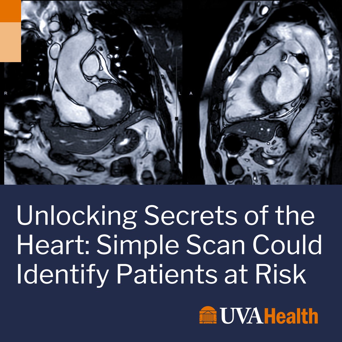UVA Health (@uvahealthnews) on Twitter photo Everyone knows the health risks of carrying too much fat around the waist and hips, but <a href="/MedicineUVA/">UVA School of Medicine</a> scientists have developed a noninvasive way to assess the health risks of unseen fat around the heart.
🫀 Learn more: bit.ly/4aCdLxN Everyone knows the health risks of carrying too much fat around the waist and hips, but <a href="/MedicineUVA/">UVA School of Medicine</a> scientists have developed a noninvasive way to assess the health risks of unseen fat around the heart.
🫀 Learn more: bit.ly/4aCdLxN