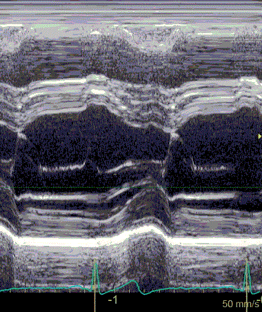AppCardioNova's tweet photo. 🫀 No subestimes el movimiento del septo interventricular

⚠️ Muchos pasan por alto las pistas que deja en la ecocardiografía.

🔍 Identificar patrones alterados puede ser la clave para el diagnóstico.

Descúbrelo en este hilo👇

#Echofirst #POCUS #CardioEd #MedEd @EchofirstB https://t.co/Iu6ZJ7mGD3
