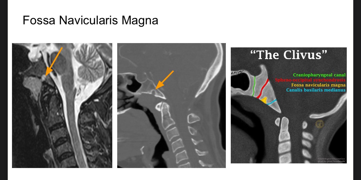 Divya Gunda (@learnneurorad) on Twitter photo Fossa navicularis magna is a benign developmental lesion manifesting as an indentation in the anterior inferior clivus. This does not need follow up, biopsy or further imaging. <a href="/drharunyildiz/">Dr Harun Yıldız</a> illustration of different developmental lesions of the clivus. #Neurorad #radres Fossa navicularis magna is a benign developmental lesion manifesting as an indentation in the anterior inferior clivus. This does not need follow up, biopsy or further imaging. <a href="/drharunyildiz/">Dr Harun Yıldız</a> illustration of different developmental lesions of the clivus. #Neurorad #radres