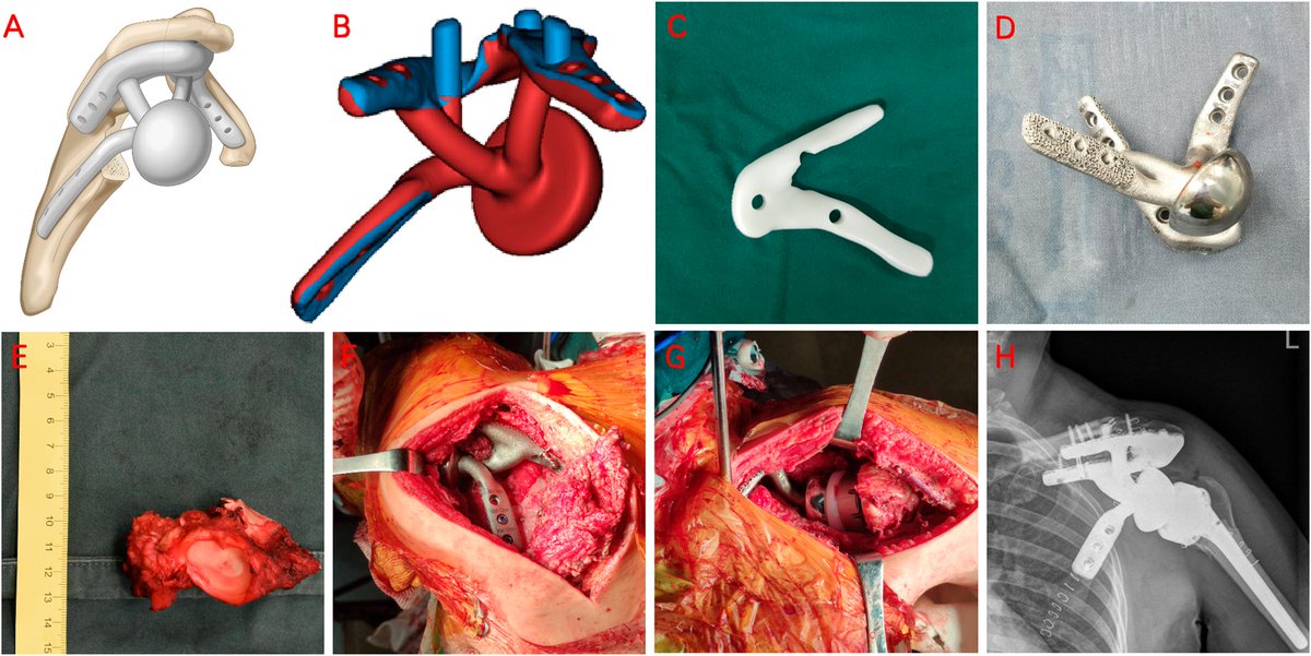 jbjs's tweet image. Novel 3D-Printed Reverse Shoulder Prosthesis for Reconstruction After Resection of the Scapular

#oncology #shoulder&amp;amp;elbow #basicscience

bit.ly/42hPwTm