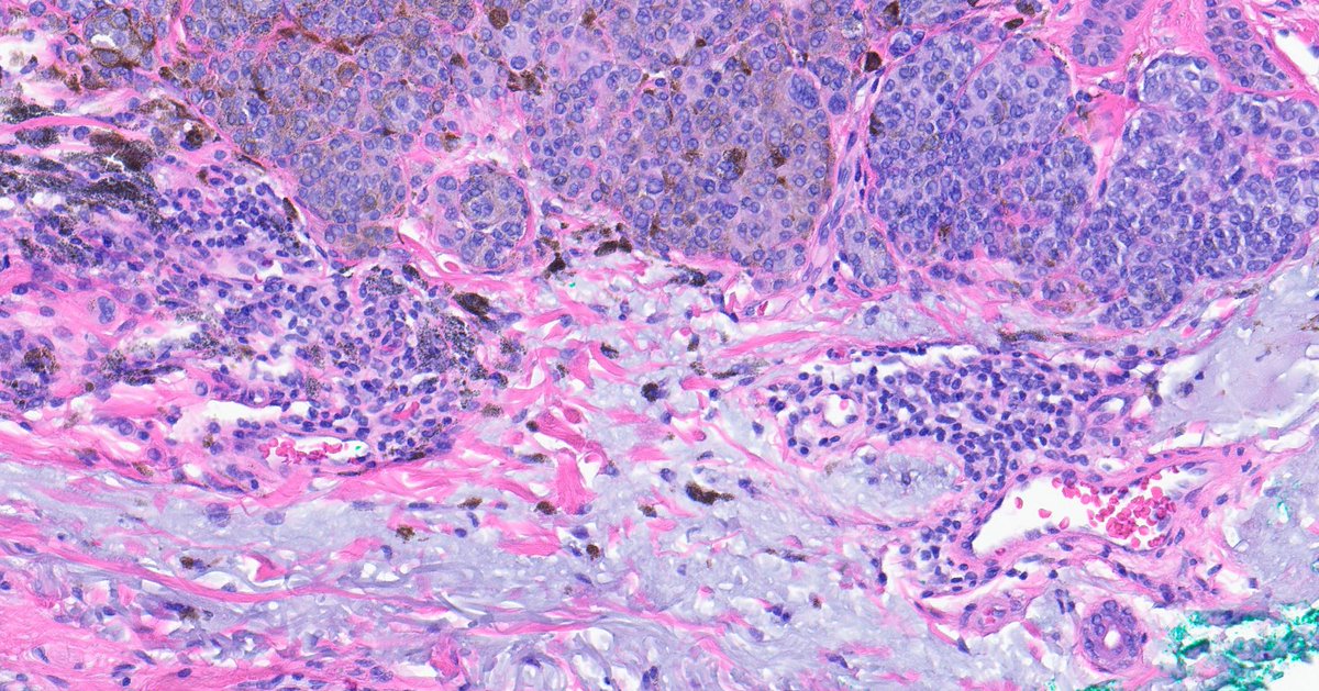 Henry YANG (@henryy_md) on Twitter photo Sun damaged skin in old individual, you will often encounter some nevomelanocytic neoplasm with heavy pigmentation. I know it can still be benign, but those pigment still bothering me... irritation related?? how do you handle this ? #dermpath <a href="/melanopath/">Arnaud de la Fouchardiere MD, PhD</a> <a href="/mccalmo/">Tim McCalmont</a> Sun damaged skin in old individual, you will often encounter some nevomelanocytic neoplasm with heavy pigmentation. I know it can still be benign, but those pigment still bothering me... irritation related?? how do you handle this ? #dermpath <a href="/melanopath/">Arnaud de la Fouchardiere MD, PhD</a> <a href="/mccalmo/">Tim McCalmont</a>