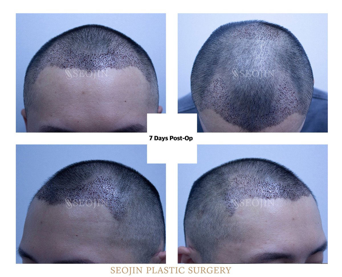 seojinps_eng's tweet photo. ๐งโโโจDramatic #HairTransplant Results!
โ Adjust proportions
โ Create a more #YouthfulFace
โ Reduce a #LargeForehead
Get an estimate for the number of #grafts you need, even from abroad!
https://t.co/MjDV1o2je7
*Estimates may differ after an in-person consultation. https://t.co/DF2JOQSlTc