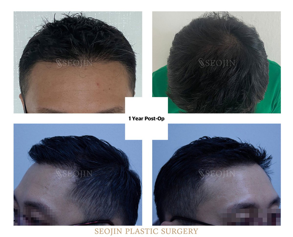 seojinps_eng's tweet photo. ๐งโโโจDramatic #HairTransplant Results!
โ Adjust proportions
โ Create a more #YouthfulFace
โ Reduce a #LargeForehead
Get an estimate for the number of #grafts you need, even from abroad!
https://t.co/MjDV1o2je7
*Estimates may differ after an in-person consultation. https://t.co/DF2JOQSlTc