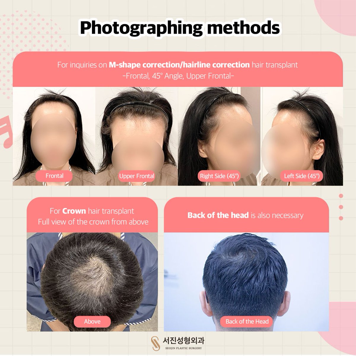 seojinps_eng's tweet photo. ๐งโโโจDramatic #HairTransplant Results!
โ Adjust proportions
โ Create a more #YouthfulFace
โ Reduce a #LargeForehead
Get an estimate for the number of #grafts you need, even from abroad!
https://t.co/MjDV1o2je7
*Estimates may differ after an in-person consultation. https://t.co/DF2JOQSlTc