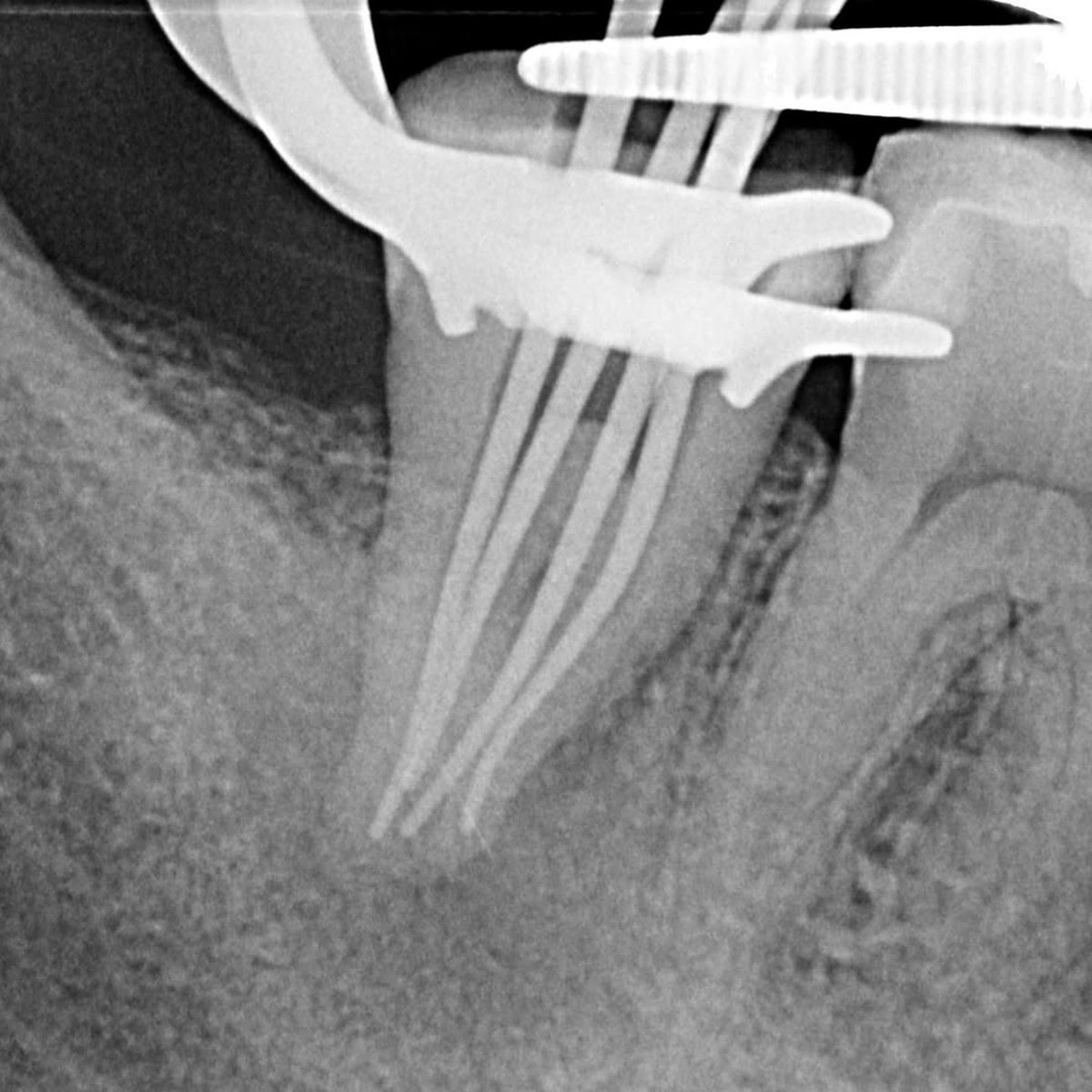 Dentagama's tweet photo. C-shaped canals varies in complex forms. https://t.co/ZlyolagGCV