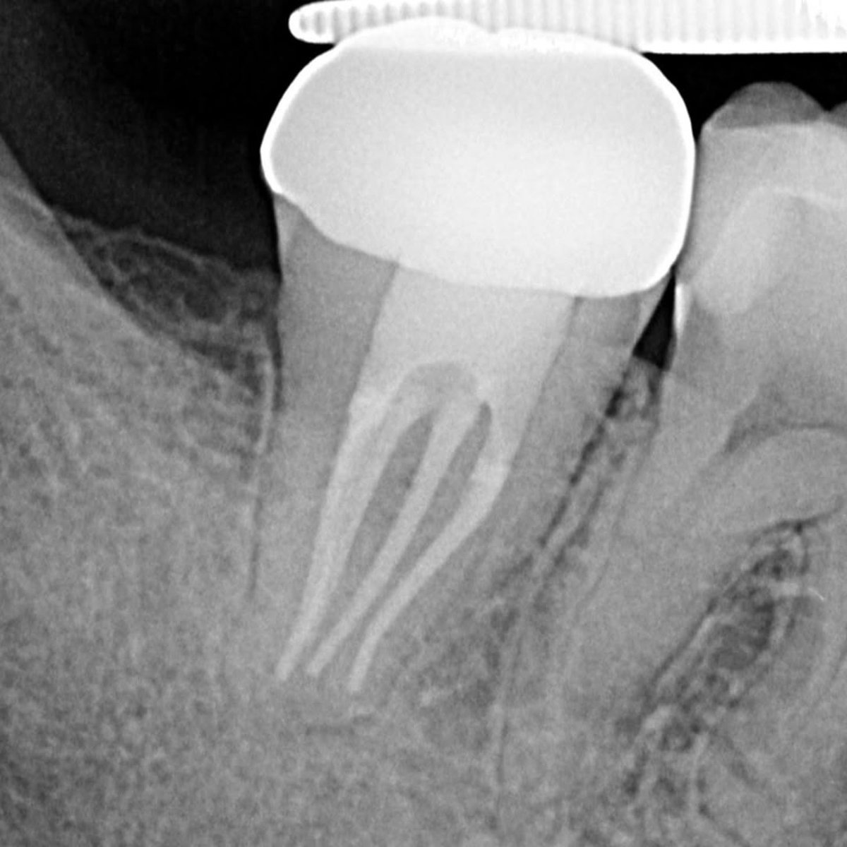 Dentagama's tweet photo. C-shaped canals varies in complex forms. https://t.co/ZlyolagGCV