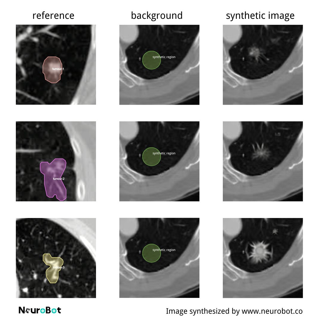 AnnaGuan07's tweet photo. 📢✨ Boosting Brain Tumor Segmentation with Synthetic Data!

Tumor segmentation is crucial for diagnosis, but challenging due to image quality and tumor diversity. Synthetic data helps improve model accuracy and real-world results!

#BrainTumor #MedicalAI #SyntheticData #Cancer https://t.co/sUkigYXyP4
