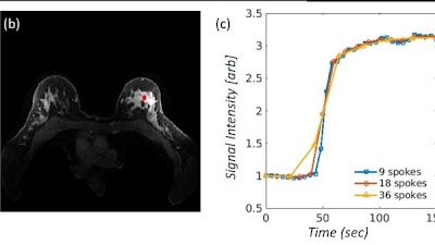 Radiology_AI's tweet photo. First large-scale dataset of radial k-space &amp; DICOM data for breast DCE MRI with case-level labels https://t.co/DSOD00v51m @ESolomonMRI @WeillCornell @FAU_Germany #OncoRad #AI #MachineLearning https://t.co/uBLYokAAPp