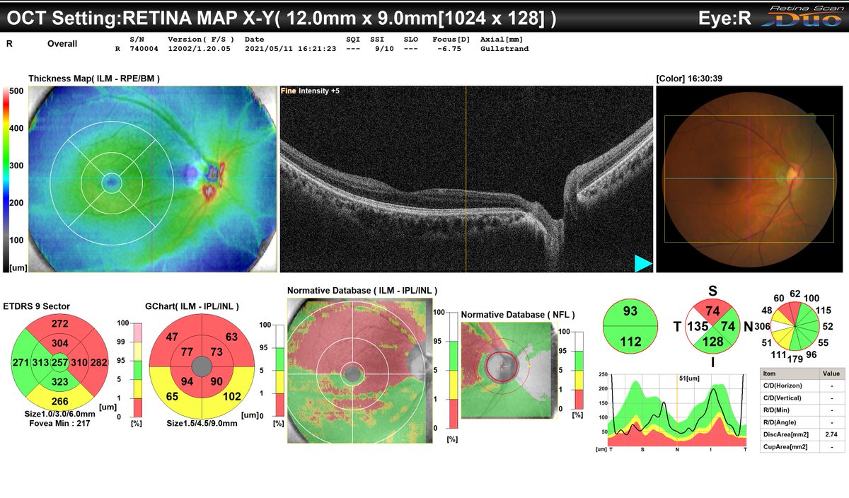 ordamed's tweet photo. 🔴 OCT (Optical Coherence Tomography) is a cutting-edge tool that enables ophthalmologists to examine eye structures with unparalleled precision.

What can be diagnosed?
✔️ Retinal diseases (diabetic retinopathy, age-related macular degeneration).
✔️ Glaucoma — analysis of the optic nerve and anterior chamber angle.
✔️ Central serous chorioretinopathy.
✔️ Postoperative monitoring.