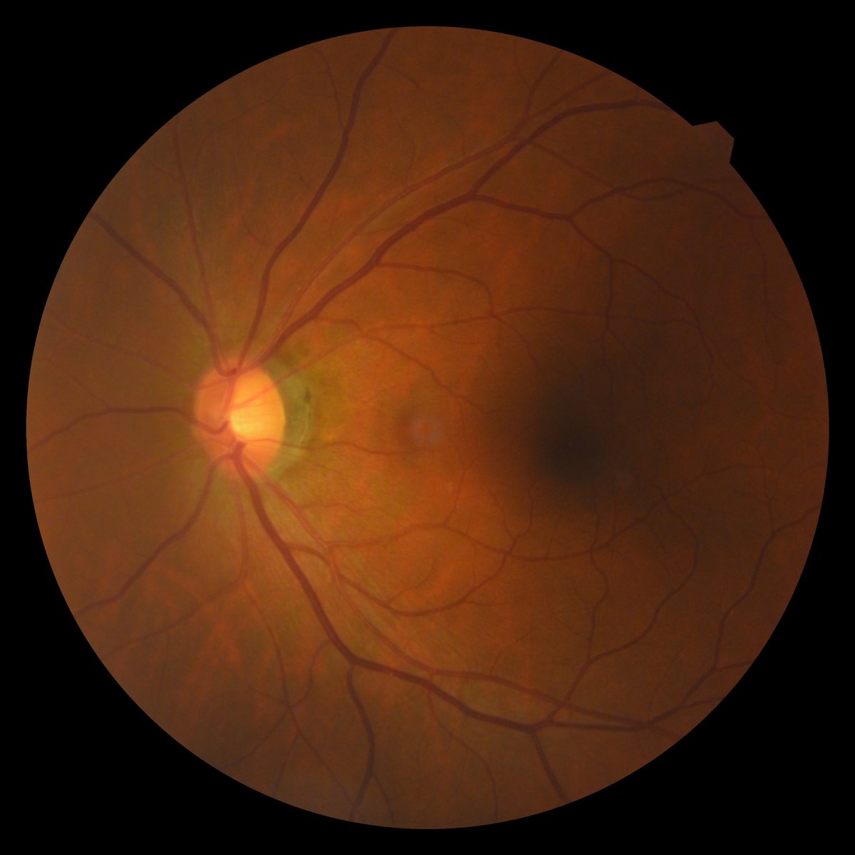 ordamed's tweet photo. 🔴 OCT (Optical Coherence Tomography) is a cutting-edge tool that enables ophthalmologists to examine eye structures with unparalleled precision.

What can be diagnosed?
✔️ Retinal diseases (diabetic retinopathy, age-related macular degeneration).
✔️ Glaucoma — analysis of the optic nerve and anterior chamber angle.
✔️ Central serous chorioretinopathy.
✔️ Postoperative monitoring.