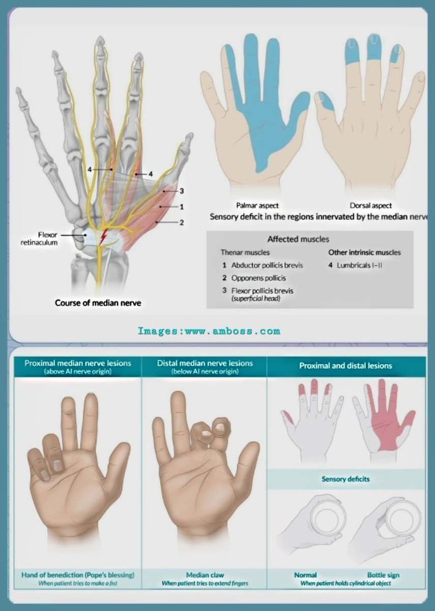 OBandarchi's tweet photo. Median nerve neuropathy 👍 A wonderful infographic by:
https://t.co/Tk5IhDHbbq https://t.co/z82IUeIJPZ