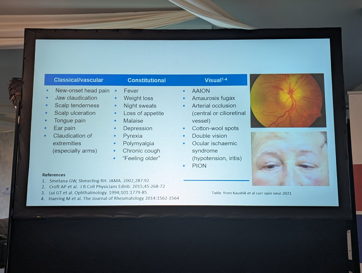 UK_headache's tweet photo. Importance of the #Eye in headache/neurology @DrMollan. Important not to miss transient monocular visual loss (imminent stroke risk). Also dry eye, visual snow, glaucoma, uveitis, GCA (cranial only may not inflammatory changes).
Fundoscopy is key.
#bashhead @uhbtrust #MedEd https://t.co/t3OxAgOslP