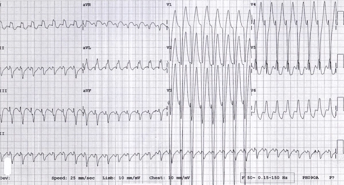 LITFL (@litflblog) on Twitter photo Sport, palpitations, and an ECG that puzzles. Can you diagnose this teen's condition? litfl.com/puzzling-parox…
#FOAMed #MedEd #MedTwitter #CardioTwitter Sport, palpitations, and an ECG that puzzles. Can you diagnose this teen's condition? litfl.com/puzzling-parox…
#FOAMed #MedEd #MedTwitter #CardioTwitter