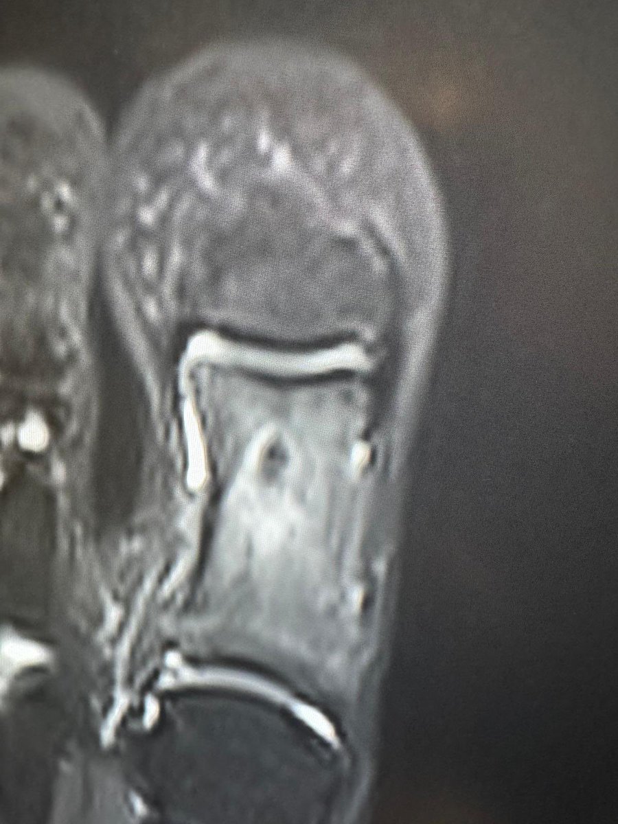 MSK Teaching Room (@mskteachingroom) on Twitter photo Here’s more imaging of the case we showed yesterday ☢️🤓
Would you obtain further imaging? 🤔🩺
<a href="/mskradiologyuk/">Professor Harun Gupta</a> <a href="/SidThakerMSK/">Siddharth Thaker (Thee/Thou/Thine)</a> <a href="/jacja_/">JJ</a> <a href="/veronica_giotas/">Veronica Giotas (Attard)</a> <a href="/AmitBharath/">Amit</a> Here’s more imaging of the case we showed yesterday ☢️🤓
Would you obtain further imaging? 🤔🩺
<a href="/mskradiologyuk/">Professor Harun Gupta</a> <a href="/SidThakerMSK/">Siddharth Thaker (Thee/Thou/Thine)</a> <a href="/jacja_/">JJ</a> <a href="/veronica_giotas/">Veronica Giotas (Attard)</a> <a href="/AmitBharath/">Amit</a>
