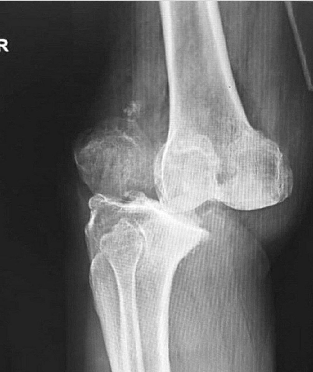 Smart1Doctor1's tweet image. Dislocation of the knee joint

To be precise, this is an incomplete dislocation of the tibia and fibula from the knee joint.

Yes, in medicine everything is always formulated in a complicated way.
.
.
.
.
#KneeDislocation #Orthopedics #Injury #MedicalTerminology #KneeHealth