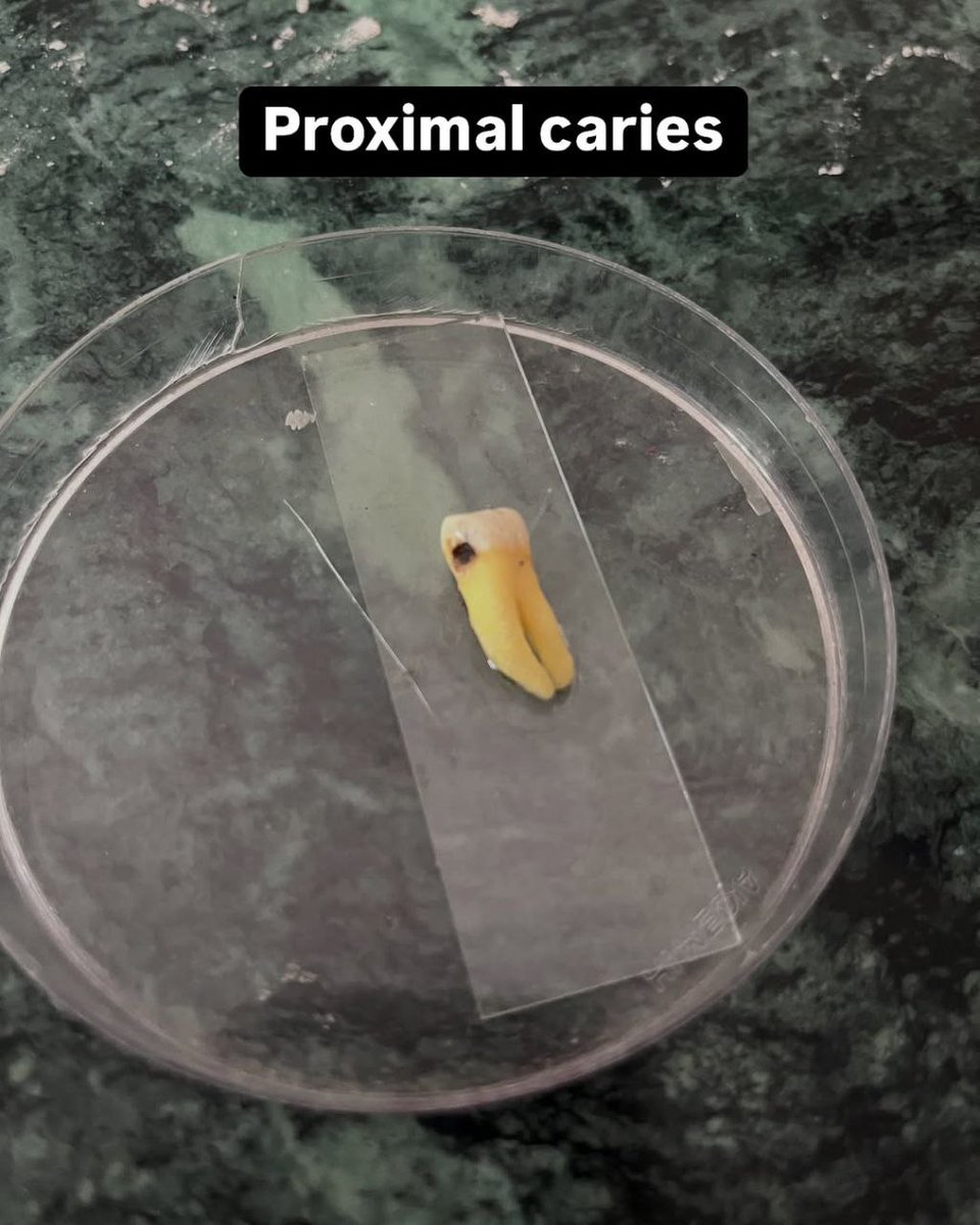 asnan_tbyb's tweet photo. Dental Caries 

Important https://t.co/LMnxDofIEe