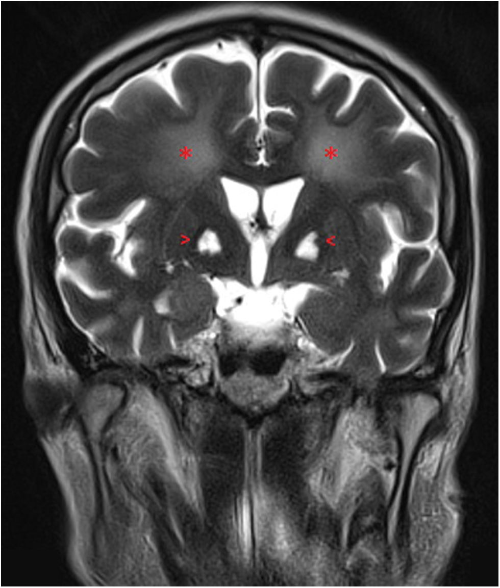 Isquemia bilateral de globos pálidos: estudio de un caso. elsevier.es/es-revista-med…