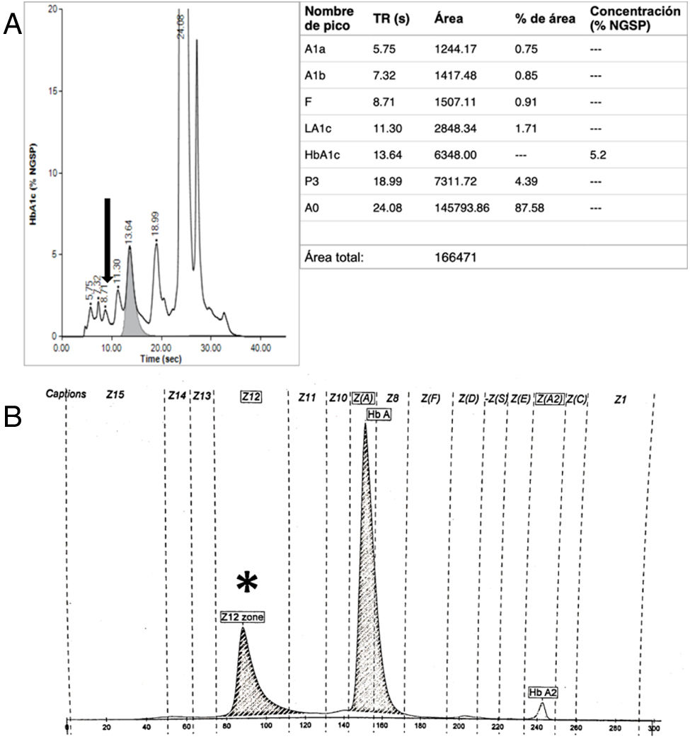 Hemoglobina Belliard, una variante a considerar. elsevier.es/es-revista-med…