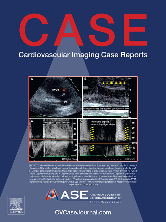 American Society of Echocardiography (@ase360) on Twitter photo Our January 2025 <a href="/CASEfromASE/">CV Case Journal</a> is online! bit.ly/3EZ3nlI
This exciting issue features:
🫀Dove-Coo Murmur From Pulmonary Regurgitation Is Associated With Tiger Stripes Sign
🫀Aortic Stenosis With Dynamic LV Outflow Obstruction
🫀Arterial Tortuosity Syndrome
🫀And more! Our January 2025 <a href="/CASEfromASE/">CV Case Journal</a> is online! bit.ly/3EZ3nlI
This exciting issue features:
🫀Dove-Coo Murmur From Pulmonary Regurgitation Is Associated With Tiger Stripes Sign
🫀Aortic Stenosis With Dynamic LV Outflow Obstruction
🫀Arterial Tortuosity Syndrome
🫀And more!
