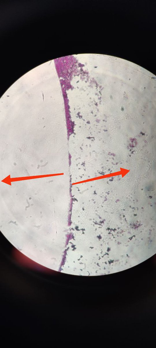 Students,  come closer.

As students,  we believe that stained slides like Gram MUST be viewed using x100.

If you ever handled CSF Gram stain, you would know how terribly frustrating it is to focus it under the microscope at x100.

The reason is that you can't make thick film
