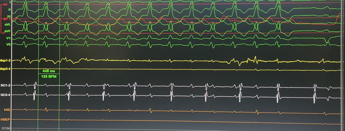 GustavoRRodrigues (@life_activist_) on Twitter photo VT ablation in a patient with ischemic heart disease and recurrent CRT-D shocks despite amiodarone. Diastolic potentials identified on anterior wall and VT interruption during RF delivery. ⚡️
<a href="/cgmarinescu/">Cătălin Marinescu</a> #JoanaPinho #PAdragao #PatriciaMatias #ClaudioHenriques #CheilaThompson VT ablation in a patient with ischemic heart disease and recurrent CRT-D shocks despite amiodarone. Diastolic potentials identified on anterior wall and VT interruption during RF delivery. ⚡️
<a href="/cgmarinescu/">Cătălin Marinescu</a> #JoanaPinho #PAdragao #PatriciaMatias #ClaudioHenriques #CheilaThompson