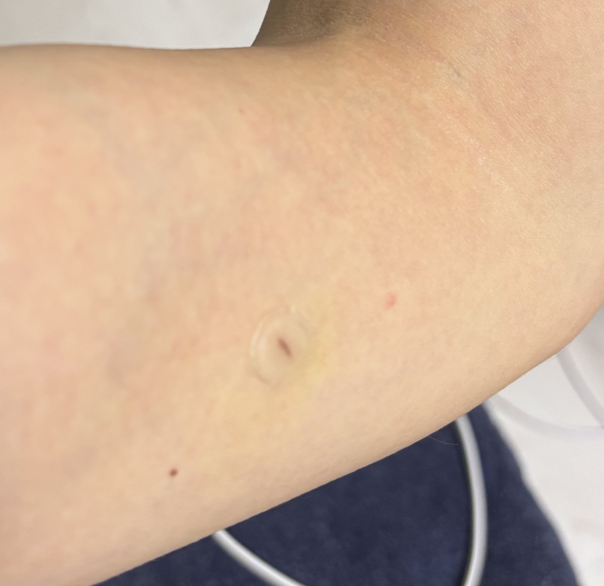 インプラノン除去後の傷跡がこちらです💁‍♀️
再生テープ貼ってる