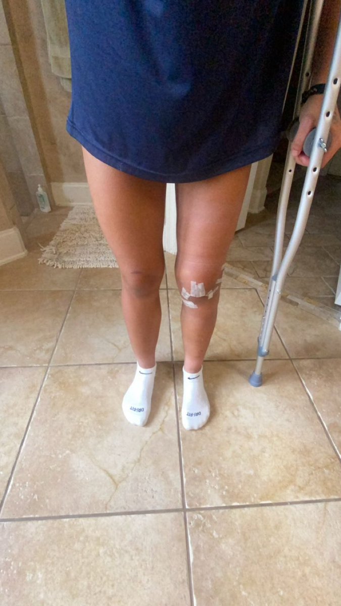 BritlandR's tweet image. In honor of  my 6 months post acl surgery here’s my muscle progression over the last 6 months! The first photo was taken on August 5th 2024 and the second was taken January 23rd 2025! Exciting things coming! 

@FCDallas08gECNL @FCDwomen @ECNLgirls @ImYouthSoccer @PrepSoccer