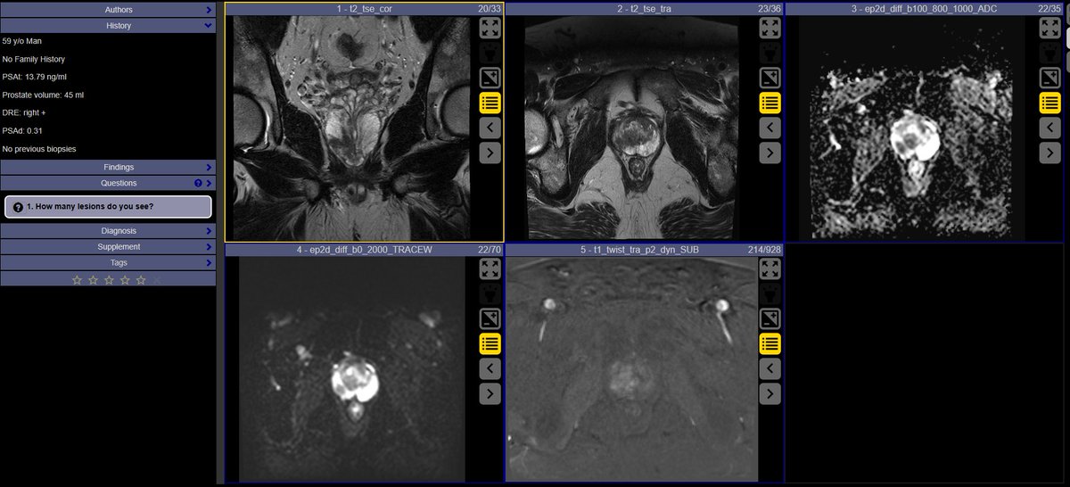 Leonardo Kayat Bit.. (@lkayat) on Twitter photo How many suspicious lesions do you see in this prostate MRI?? What are their PI-RADS scores??
Sign up for the Prostate MRI Hands-on Course at the <a href="/SocietyAbdRad/">Society of Abdominal Radiology | SAR</a> 2025 annual meeting, and find the answers to those questions and much more.
Learn from world-class faculty including How many suspicious lesions do you see in this prostate MRI?? What are their PI-RADS scores??
Sign up for the Prostate MRI Hands-on Course at the <a href="/SocietyAbdRad/">Society of Abdominal Radiology | SAR</a> 2025 annual meeting, and find the answers to those questions and much more.
Learn from world-class faculty including