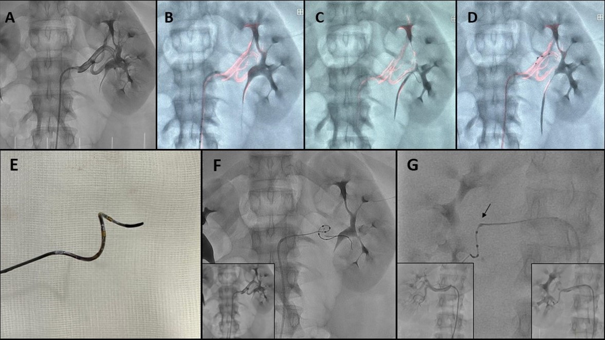 Journal of Invasive Cardiology (@invasivecardiol) on Twitter photo 6. #2024Top10 Clinical Image: Role of Dynamic Roadmapping in Renal Denervation ➡️Procedureshttps://www.hmpgloballearningnetwork.com/site/jic/clinical-images/role-dynamic-road-mapping-renal-denervation-procedures
<a href="/CardioHULP/">Cardiología La Paz</a> <a href="/Hemodin_LaPaz/">Hemodinamica_LaPaz</a> <a href="/ari_gonzalvez/">Ariana Gonzálvez</a> <a href="/JuradoRomanAl/">Alfonso Jurado-Román</a> <a href="/hemodin90/">Guillermo Galeote</a> 6. #2024Top10 Clinical Image: Role of Dynamic Roadmapping in Renal Denervation ➡️Procedureshttps://www.hmpgloballearningnetwork.com/site/jic/clinical-images/role-dynamic-road-mapping-renal-denervation-procedures
<a href="/CardioHULP/">Cardiología La Paz</a> <a href="/Hemodin_LaPaz/">Hemodinamica_LaPaz</a> <a href="/ari_gonzalvez/">Ariana Gonzálvez</a> <a href="/JuradoRomanAl/">Alfonso Jurado-Román</a> <a href="/hemodin90/">Guillermo Galeote</a>