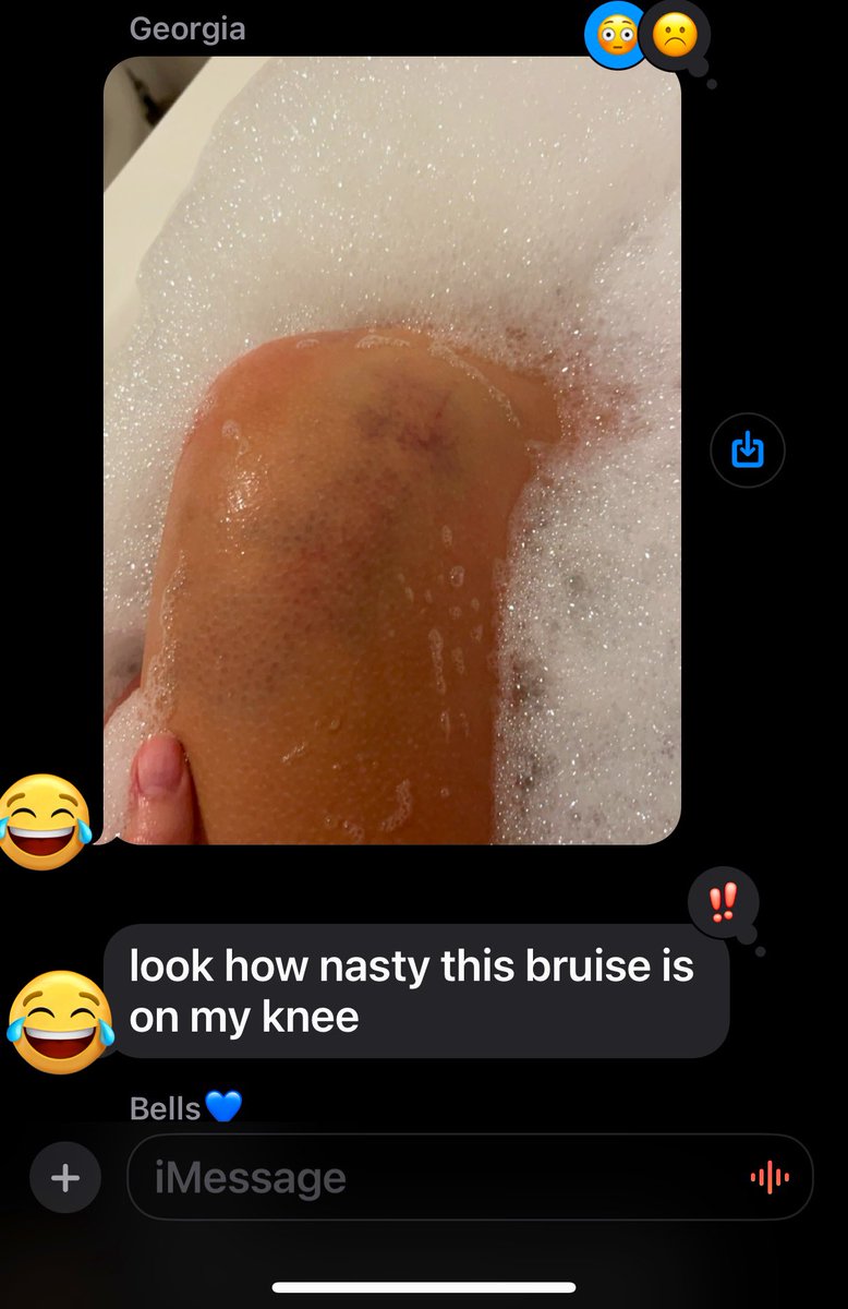 FUTUREVICTIMS's tweet photo. @hawkshootas 
her 😂😂😂knee 😂😂😂was 😂😂in 😂😂fact😂😂😂 swollen😂😂😂 https://t.co/UD3NHl3eQp